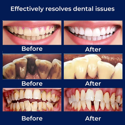 PlaqueFree Plaque Remover for teeth | Ultrasonic Teeth Cleaner - Tartar Remover from Home - Deep Teeth Cleaning and Polish