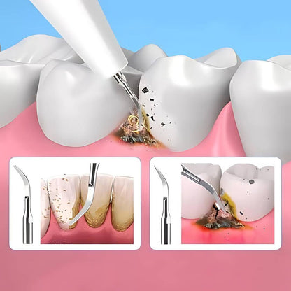 PlaqueFree Plaque Remover for teeth | Ultrasonic Teeth Cleaner - Tartar Remover from Home - Deep Teeth Cleaning and Polish